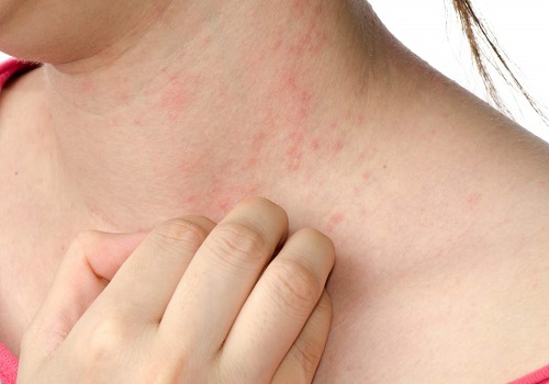 Life-threatening Disease That Cause Rash