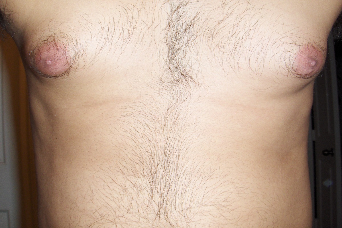 Gynecomastia- Breast Issues In Men Are For Real