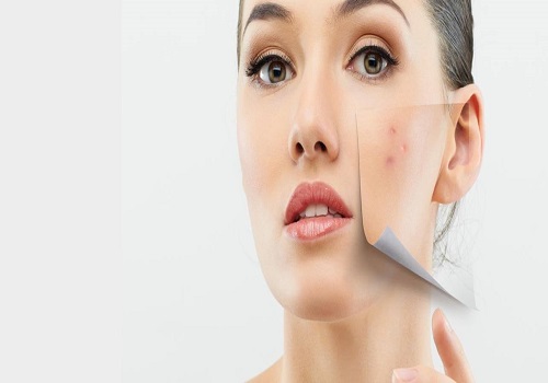 KNOW ABOUT THE MENSTRUATION RELATED PIMPLES