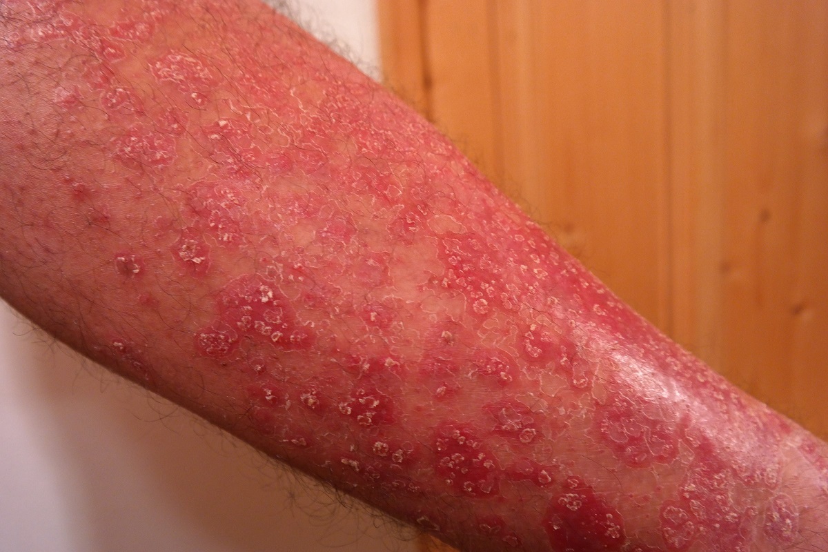 Psoriasis: 5 Things To Avoid