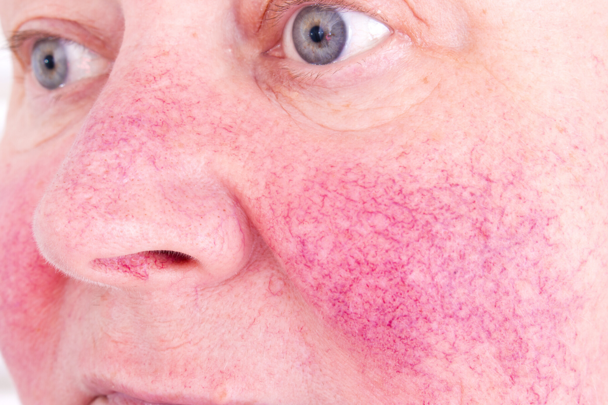 Rosacea: Types, Symptoms And Causes