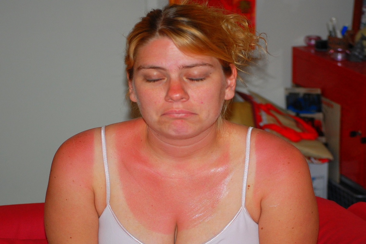 How Does One Treat A Sunburn?